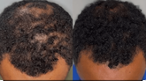 Before and after comparison of a person's scalp and hair growth.