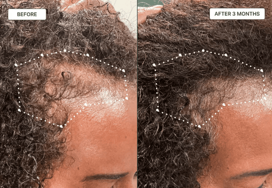 hair oil for thinning edge