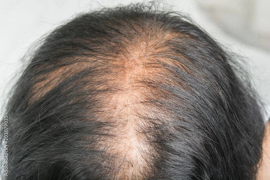 Hormone Imbalance and Hair Loss: Natural Ways to Stimulate Regrowth