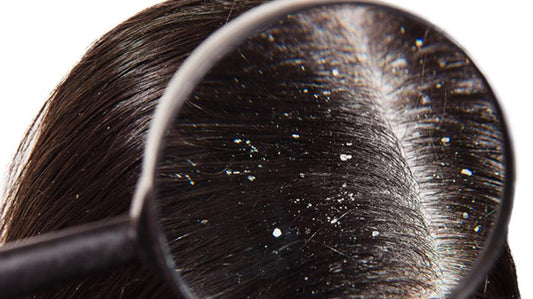 Close-up view of a scalp showing flakes while discussing Why Your Scalp Itches Even When Hair Is Clean.