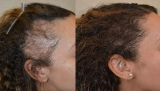 Before and after Hair growth