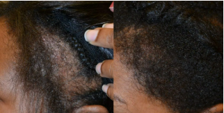 Before and after Hair growth