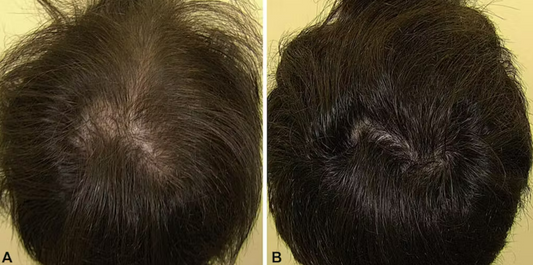 Before and after Hair growth men